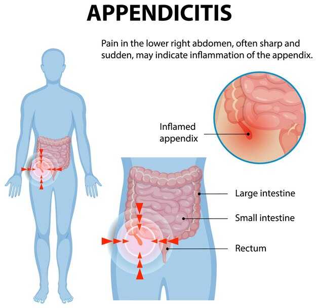 Локализация боли при аппендиците