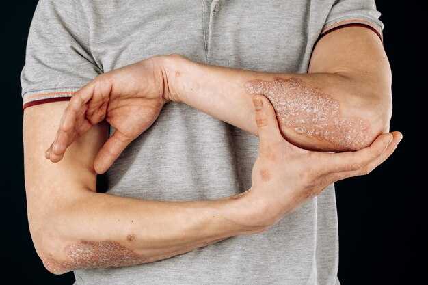 Ошибки в понимании витилиго