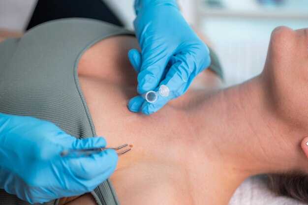 Отзывы людей об использовании йода для удаления папиллом